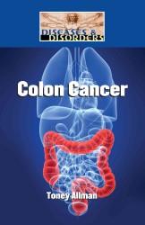Colon Cancer (Diseases & Disorders) （Library Binding）