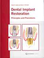 The Restoration of Dental Implants with Fixed Prosthesis