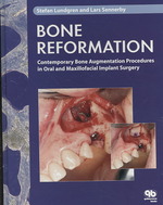 Bone Reformation : Contemporary Bone Augmentation Procedures in Oral and Maxillofacial Implant Surgery