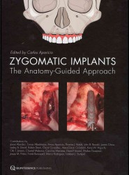 Zygomatic Implant