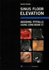 Sinus Floor Elevation : Avoiding Pitfalls Using Cone-Beam CT