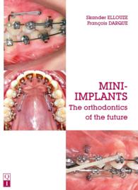 Mini-Implants : The Orthodontics of the Future