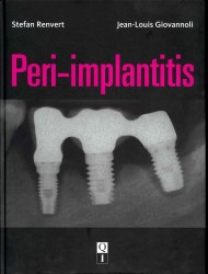 Peri-implantitis