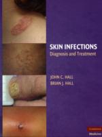 Skin Infections : Diagnosis and Treatment