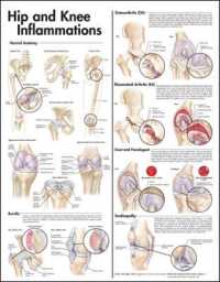 Hip and Knee Inflammations Anatomical Chart （2ND）