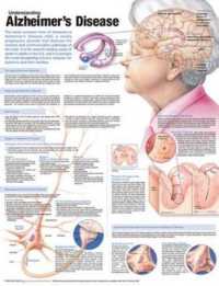 Understanding Alzheimer's Disease Anatomical Chart （2ND）