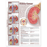 Understanding Kidney Cancer Anatomical Chart （1 LAM WAL）