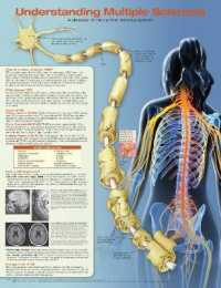Understanding Multiple Sclerosis Anatomical Chart （2ND）