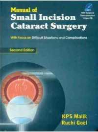 Manual of Small Incision Cataract Surgery （2ND）