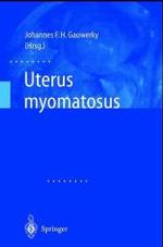 Uterus Myomatosus