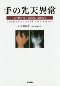 手の先天異常 - 発生機序から臨床像，治療まで