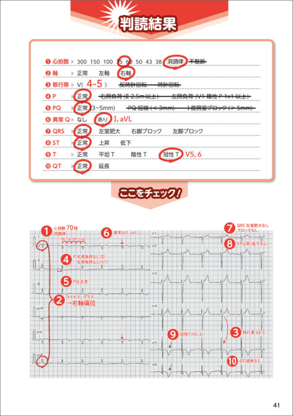 読み方だけは確実に身につく心電図_4