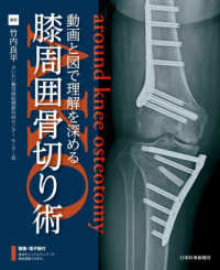 膝周囲骨切り術（ＡＫＯ）