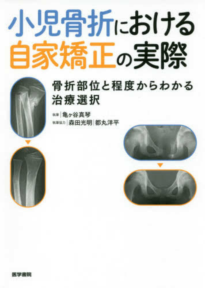 小児骨折における自家矯正の実際 / 亀ヶ谷真琴/森田光明
