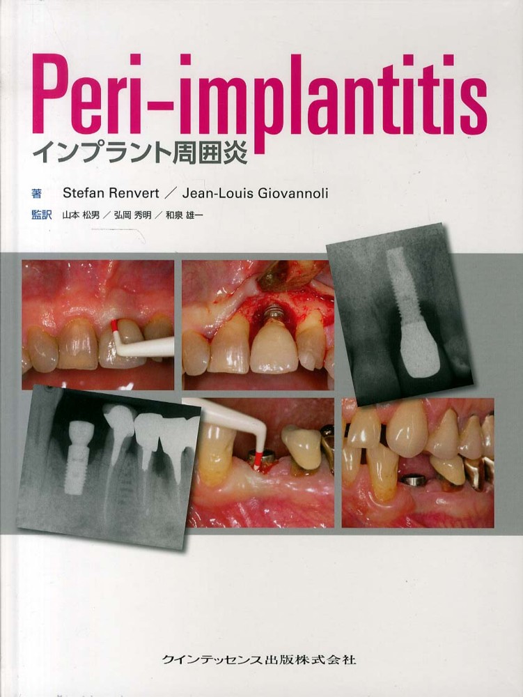 口コミ サイト 商品 Peri－implantitis / レンバート，ステファン 健康+医学
