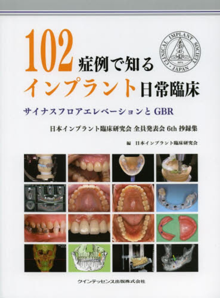 １０２症例で知るインプラント日常臨床　日本インプラント臨床研究会【編】　紀伊國屋書店ウェブストア｜オンライン書店｜本、雑誌の通販、電子書籍ストア